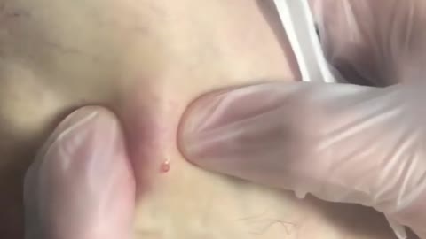 Giants Deep Blackheads, Whiteheads, Big Pimples, Hidden Acne Removal - Best Popping Videos #000025