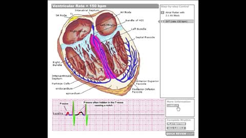 Dr Stanley's ECGcourse.com | Special Case Ventricular Rate = 150 bpm Tutorial