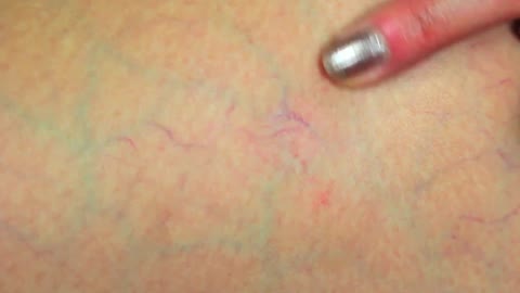 Spider Vein Home Treatment - Before and After Results