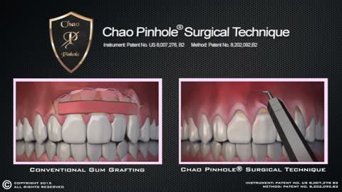 Chao Pinhole Surgical Technique Vs. Conventional Gum Grafting