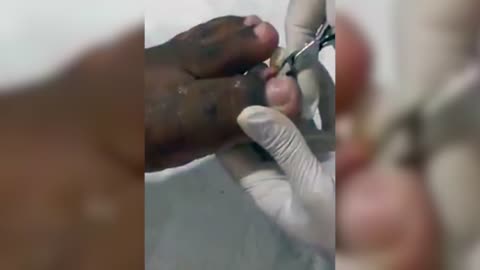 NSFW - The Nastiest Ingrown Toe Nail