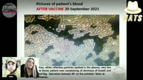 Must watch!💉☠️ Dr. Zandre Botha shows images of Covid-19 vaccine damage in the blood