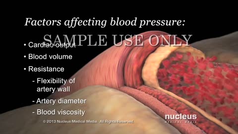 High blood Pressure (Hypertension ) Causes & Treatment