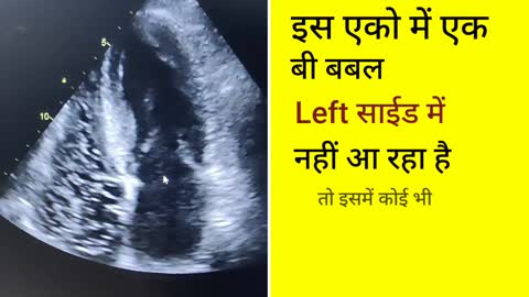 Bubble contrast Echo for pfo ll Bubble study ll Right to Left shunt को डिटेक्ट करना