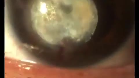 QUERATOPATÍA LÍPIDIDICA ASOCIADA A HIDROPS CORNEAL