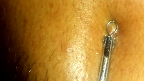 Extracting blackhead / Whitehead