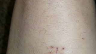 Knee Surgery