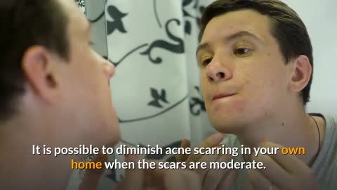 The Truth About Removing Acne Scarring