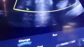 Ultrasound of baby at 25 weeks