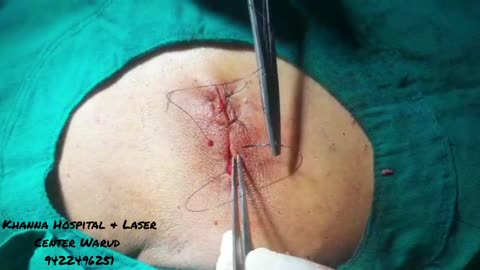 lipoma excision under local anesthesia