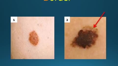 Skin Cancer Education With Warning Signs Including Photos