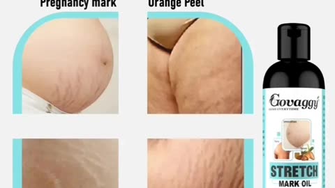 Stretch marks problem solving product
