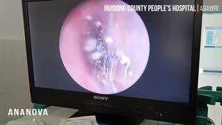 Woman Finds Spider Nesting In Her Ear