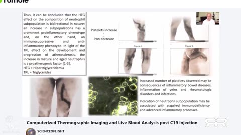 Thermographic Imaging Shows Massive Blood Clots in the Asymptomatic Vaxxed