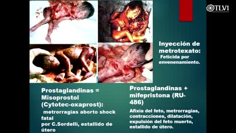 Especial TLV1 N°01 - Aborto, ¿Vida o Muerte_ Dra. Chinda Brandolino