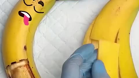 Golden banana 🍌 surgery