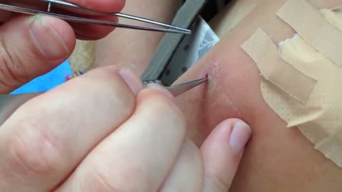 Botfly Maggot Removal