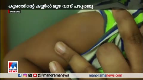 Child suffered swelling in arm following measles rubella vaccination