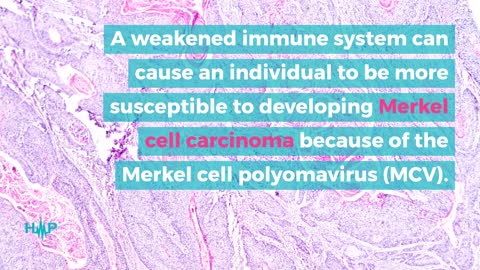 What Increases The Risk Of Merkel Cell Carcinoma?