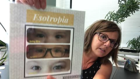 Significant Esotropia Improvement With Vision Therapy