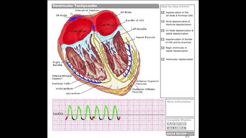 Dr Stanley's ECGcourse.com | Ventricular Tachycardia Tutorial