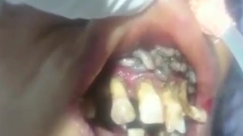 Hundreds of Maggots inside mouth. Viewer discretion is advised.