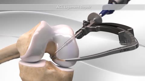 Everything You Need to Know About ACL Reconstruction Surgery