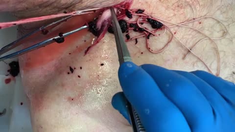 Richard Hirschman removes large 'clot' from common carotid artery of the deceased