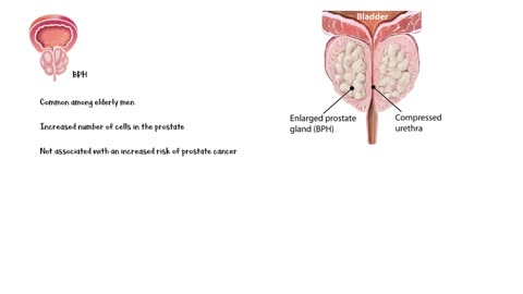 Signs That You Have Prostate Disease _Warning Signs Of Prostate Disease (Cancer_)