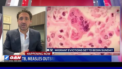 Chicago Shelters for Illegal Immigrants Grapple with Measles and TB Outbreaks; Officials Under Fire