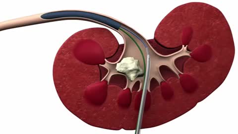 Литотриптор LMA StoneBreaker™ Animation Combined PCNL