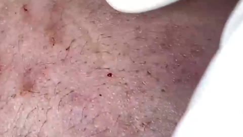 Giants Deep Blackheads, Whiteheads, Big Pimples, Hidden Acne Removal - Best Popping Videos #000024