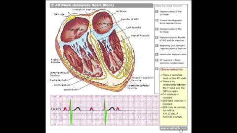 Dr Stanley's ECGcourse.com | Third Degree AV Block (Complete Heart Block) Tutorial