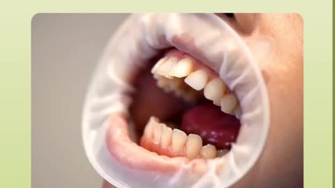 metal braces for teeth